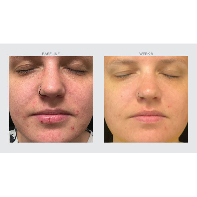 Pore Refining Acne Serum